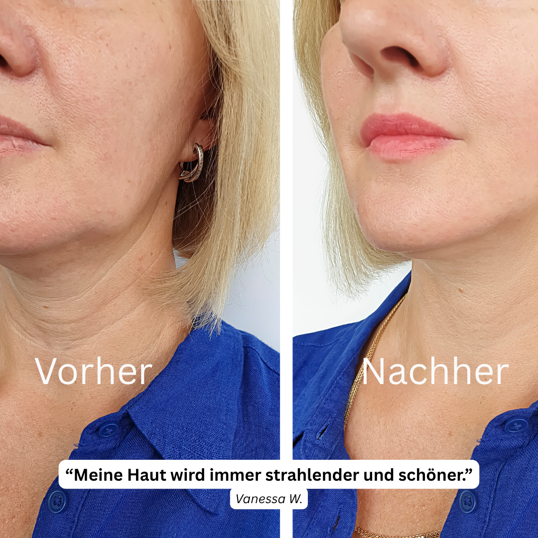 Vorher Nachher NuVibe Kollagen